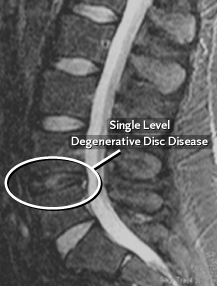 Doença degenerativa do disco (DDD)