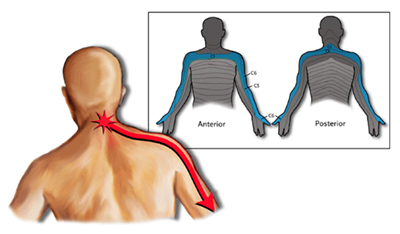 radiculopatia